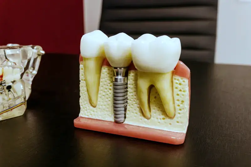 A cut-away teaching model showing an implant screw in the jaw between two natural teeth